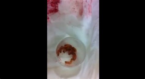 Graphic Video Doctors Remove Live Maggots From Girl With New Std