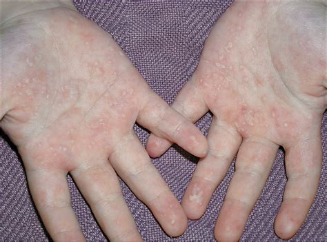 Vesicular Eczema After Intravenous Immunoglobulin Therapy For Treatment