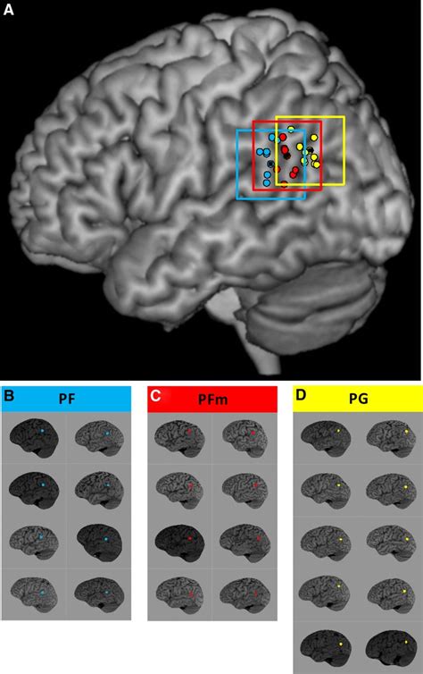 Transcranial Direct Current Stimulation Tdcs Of Left Parietal Cortex
