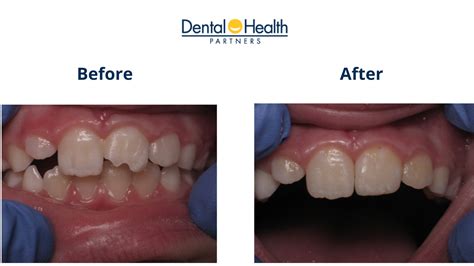 Composite Bonding Before And After Tooth Restoration Dental Health