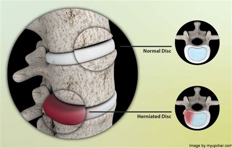 These Common Pain Symptoms May Indicate Herniated Disc Aka “slipped