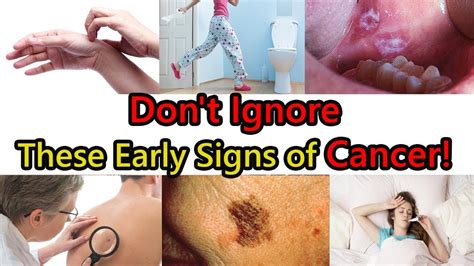11 Early Warning Signs Of Cancer You Should Not Ignore Youtube