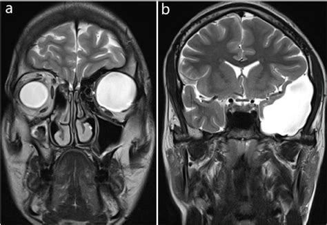 Cureus Arachnoid Cyst In Middle Cranial Fossa With Intraorbital Cyst