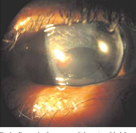 Figure 1 From Spontaneous Resolution Of Corneal Oedema After