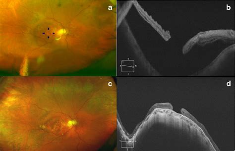 Pseudophakic Patient With A Recurrent Retinal Detachment Secondary To