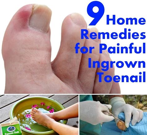 Here are six best methods to cure ingrown hair. 9 Home Remedies for Painful Ingrown Toenail | DIY Home Things