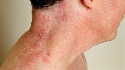 Rosacea Acne Shingles Covid 19 Rashes Common Adult Skin Diseases Images