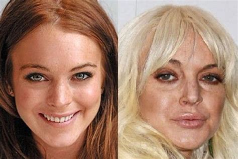 Pin On Celebrity Plastic Surgery Before And After Photos