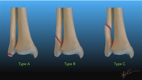 Danis Weber Classification Of Ankle Fractures UW Emergency Radiology