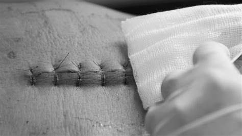 How To Suture A Wound Laceration Repair And Recovery