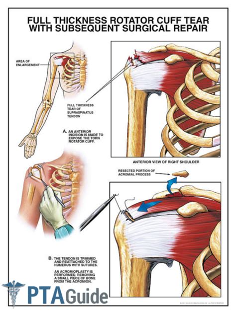 The Complete Rotator Cuff Tear Guide For Physical Therapy Assistants