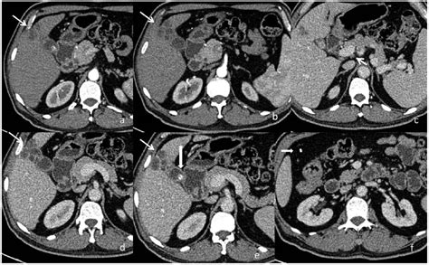 Gallbladder Tuberculosis Camouflaging As Gallbladder Cancer Case