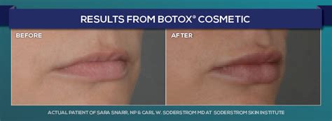 Turn That Frown Upside Down The Basics On Botox And Fillers