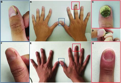 Clinical Image Of Case 2 A D Nail Plate Of A Patient With