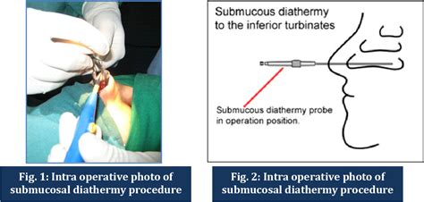 Figure 3 From Comparison Of Partial Inferior Turbinectomy And