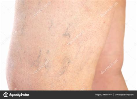 Varicose Veins On A Leg Stock Photo By ©cunaplus 143994059