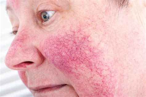 Rosacea Vs Lupus Butterfly Rash