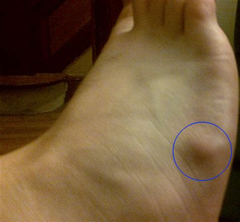 ganglion cyst on top of the foot what is it feet firs