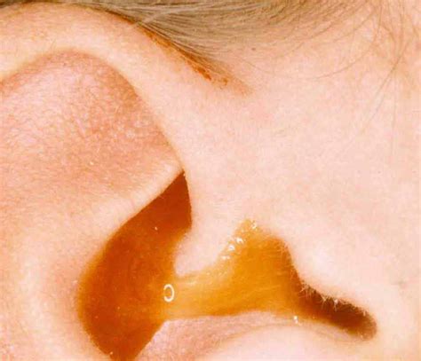 Fluid Draining From The Ear Types Causes And Treatment