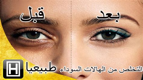 يعتبر التهاب البروستاتا مرضًا شائعًا وتختلف أعراضه بحسب نوعه وكذلك أسبابه وطرق علاجه، إليك التفاصيل فيما يلي التهاب البروستاتا: علاج الهالات السوداء تحت العين عند الرجال , تعرف علي اقبح ...