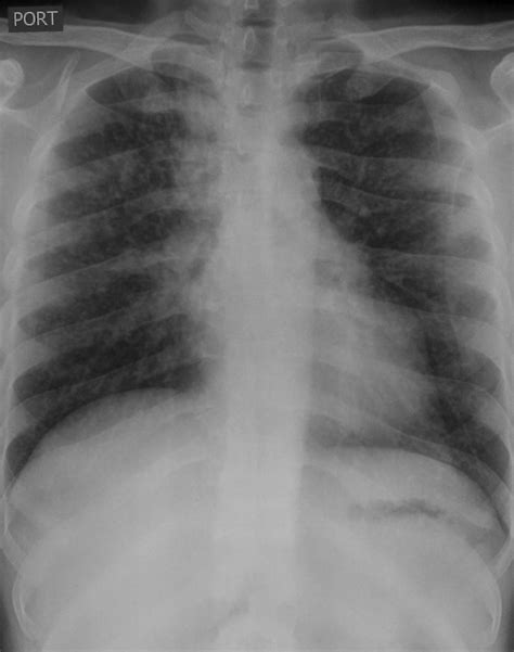 Learning Chest Radiology Case 145 Miliary Tb