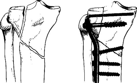 Figure 1 From The Tibial Plateau Fracture The Toronto Experience 1968