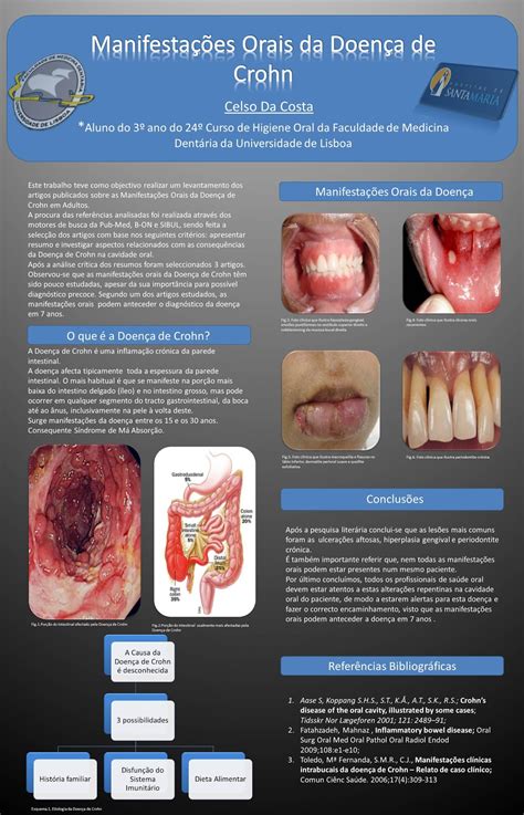 No entanto, um tratamento bem feito combinado com mudanças de hábitos de vida como. Manifestações Orais da Doença de Crohn - O Higienista Oral ...