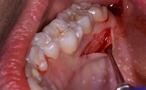 Soft Tissue Around Dental Implants Dental Cpd Courses Bpi Education