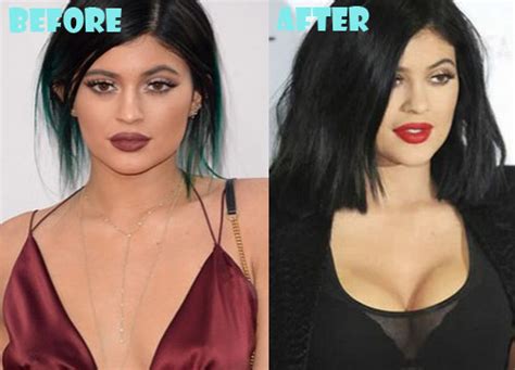 Kylie Jenner Plastic Surgery Before and After Pictures ...