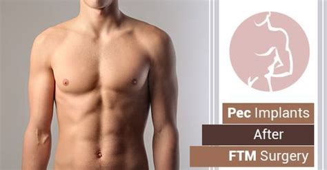 Can You Get Pec Implants After Ftm Surgery Mclean Clinic