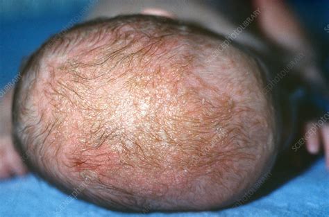 Seborrheic Dermatitis Stock Image C0270663 Science Photo Library