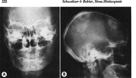 Figure 1 From Sinus Histiocytosis With Massive Cervical Lymphadenopathy