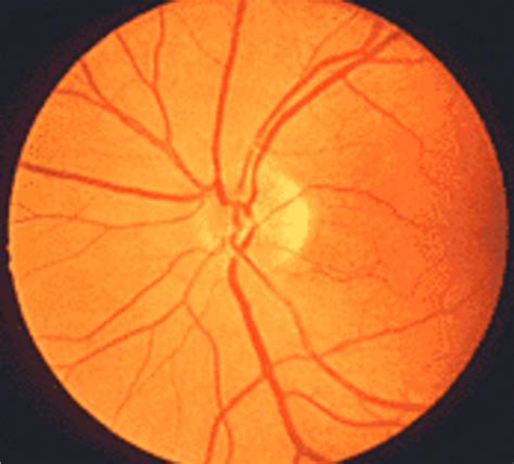 Normal Fundus And Early Pion Note Normal Fundal Appearance