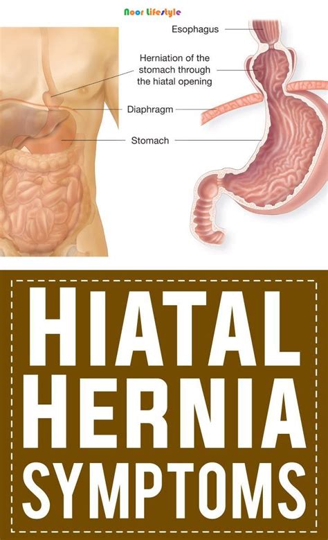 Pin On Diet For A Hiatal Hernia