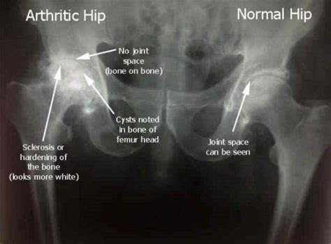 Hip Arthritis Osteoarthritis Orthopaedic Associates
