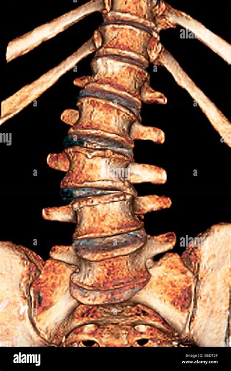 Arthritis Of The Spine Frontal Coloured 3d Computed Tomography Ct