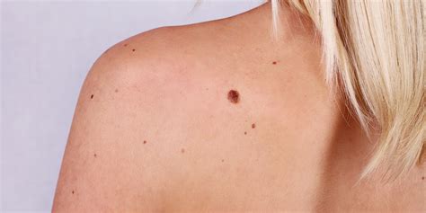 We did not find results for: Majority Of Melanoma Skin Cancer Patients 'Do Not Have ...