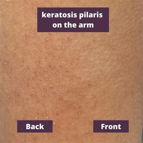 Treating Keratosis Pilaris The End Of Small Pimples Inoya