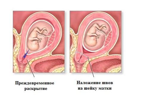 укороченная шейка матки при беременности 33 недели что делать