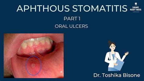 Aphthous Stomatitis Part 1 Oral Ulcers Youtube