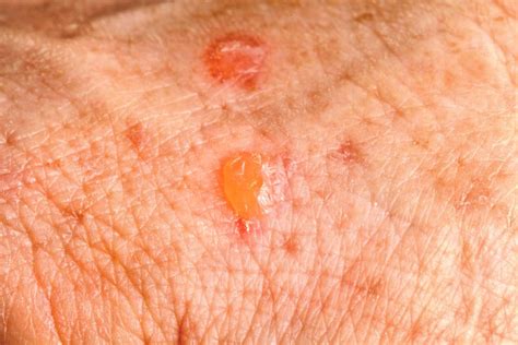 Skin Cancer And Rashes Cancerous And Precancerous Lesions