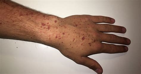 Blister Rash On Arm