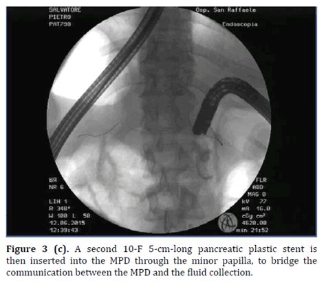 Ercp Guided Endoscopic Therapy For Recurrent Acute Pancreatitis In