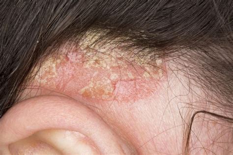 Effective Relief Of Scalp Psoriasis May Be In Sight Dermatology Advisor
