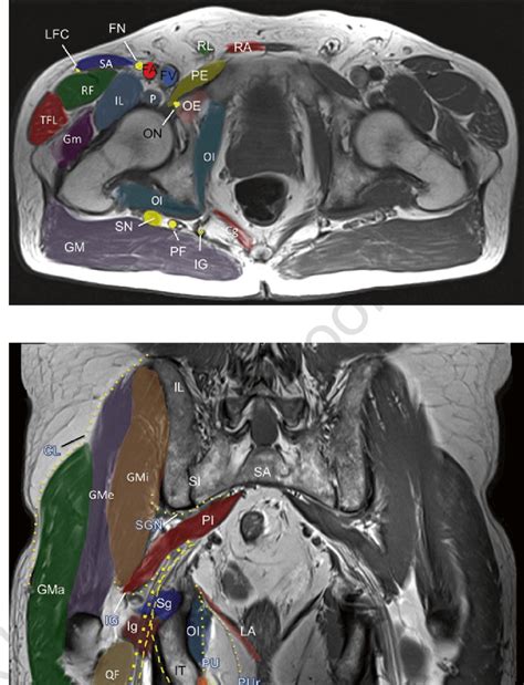 A pelvis mri (magnetic resonance imaging) scan is an imaging test that uses a machine with powerful magnets and radio waves to create pictures this mri pelvis cross sectional anatomy tool is absolutely free to use. 5 MRI axial image of pelvis. Cg coccygeus muscle, FA ...