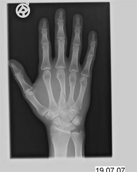 Normal Hand X Ray