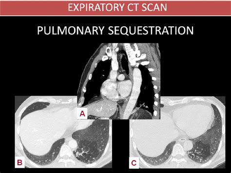 Figure 3 From What Every Radiologist Should Know About Expiratory And