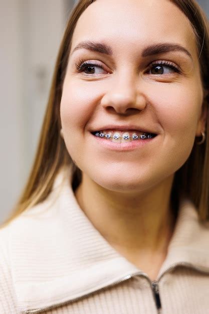 Premium Photo Closeup Of A Woman S Face With Braces On Her Teeth Orthodontic Treatment Of Teeth