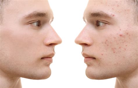 Get Acne Treatment Online - TeleMed2U