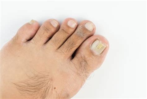 Thick Toenails Symptoms Causes And Treatment In 2021 Thick